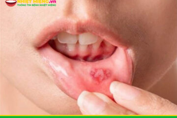 Nhiệt miệng kiêng không nên ăn gì?